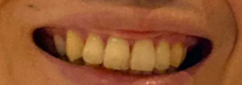 ホワイトニングを受ける前の筆者の歯